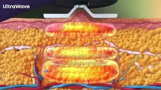 טכנולוגיות יחודיות של אלמה - Alma Lasers