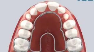 Crozat Appliance (Top  View)