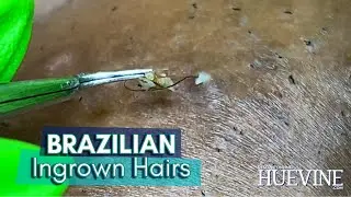 Removing Embedded Hairs From A Brazilian Laser Hair Removal 