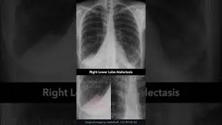 Right Lower Lobe Atelectasis Chest X-ray 