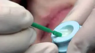 Topical Fluoride
