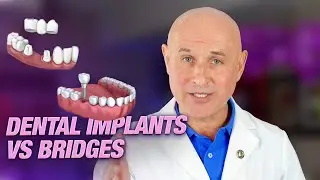 Implants vs Bridge Work: Which Is Best for You? - Expert Insights from Dr. Dmitry Gorbatov