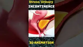 Understanding Stress Urinary Incontinence (SUI): Causes, Symptoms, and Solutions