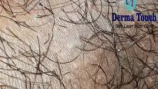 Derma Touch Pediculosis Pubis, Body Louse, Insect on Body