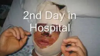 My Facial Feminization Surgery