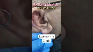 Ear we go again #skincare dr khaled sadek examines LIPOMACYST