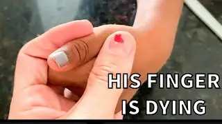 SMASHED FINGER IS BRUISING AND DYING AND I'M WORRIED ABOUT IT