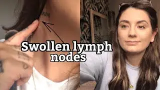 Swollen Lymph Nodes & Health Anxiety| RESULTS