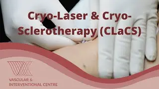 What is Cryo-Laser and Cryo-Sclerotherapy (CLaCS)? Treatment for Varicose and Spider Veins.