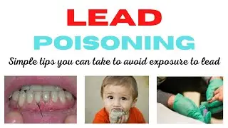 Lead poisoning (Lead Toxicity) | Lead Poisoning Symptoms | Lead Poisoning Treatment