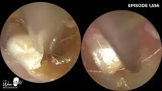 1,556 - Layers of Dead Skin Stripped Away From Ear