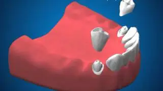 Ортопедическая стоматология  Замещение дистальных дефектов зубного ряда кламмерным бюгелем НЧ)
