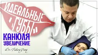 Увеличение губ филлерами (канюля) Dr.Valeriy Potiy