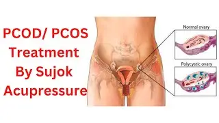 Treat PSOD /PCOS Naturally by Sujok Acupressure