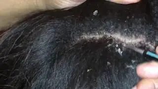 Dandruff Flakes! Pt. 2 of 4