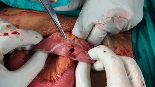 Ileal perforation repair | Air under diaphragm
