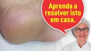 CALCANHAR RESSECADO RESOLVA EM CASA