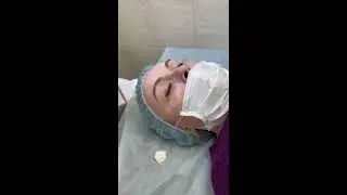 Электрокоагуляция миллиума и кератомы