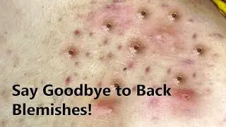 Combatting Blackheads on Back: Effective Solutions for Clearer Skin