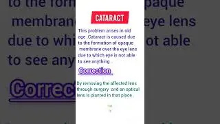Cataract