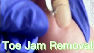Toe Jam Removal (Must Watch)
