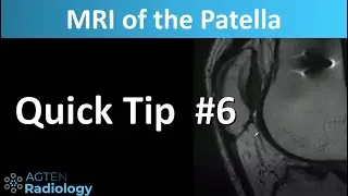 MRI of the Patella: The Patellar Calcar