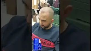 saç çıkartan dermanew hair losyon