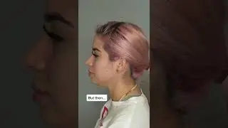 Chin Liposuction BEFORE & AFTER 