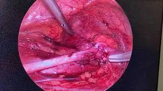 4 yaş UPJ (ÜRETEROPELVİK BİLEŞKE DARLIĞI) DARLIK OPERASYON HİKAYEMİZ, DOÇ DR SERDAR AYKAN