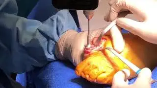 1st Metatarsophalangeal Joint (MTPJ) Fusion