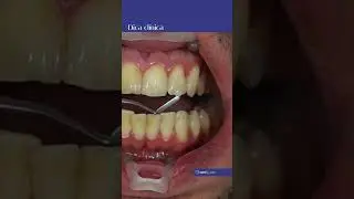 Como fazer seleção de cor de resina composta #dentista #estudantedeodonto #shorts
