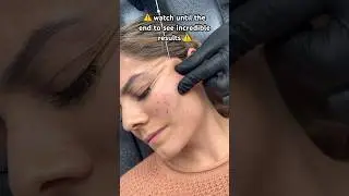 ‼️ TW ‼️ Would you try a thread lift? 👀 Results at the end! 