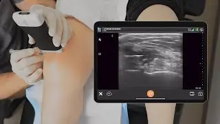 PRP Knee Injection Post Aspiration