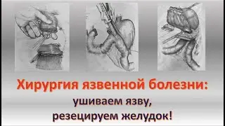 Хирургия язвенной болезни (часть 1)
