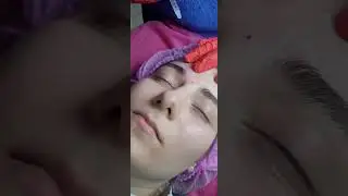 Токсин верх. Depressor  supercilii muscle (фрагмент).