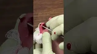 Removal of Ingrown Toenail
