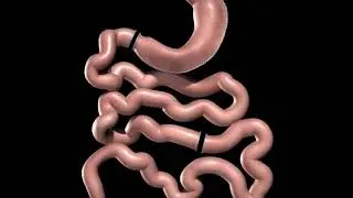 The Duodenal Switch Procedure in Houston | Texas Laparoscopic Consultants