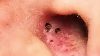 Blackhead In The Ear Extracted - Removing Blackheads from the Ear