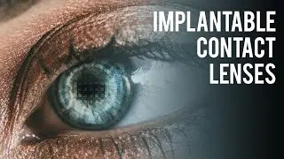 IMPLANTABLE CONTACT LENSES (ICL) Before and After