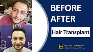 Hair Transplant Turkey | Saç Ekimi İstanbul | Saç Ekimi | İstanbul Stella Hair Clinic