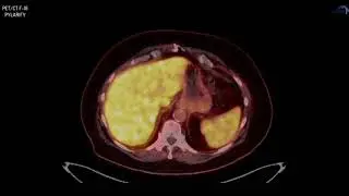 PSMA PET/CT F-18 Pylarify case 4