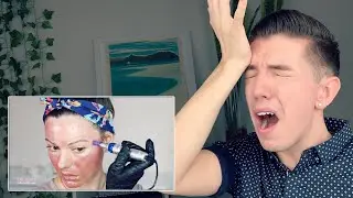Specialist Reacts to DIY Microneedling
