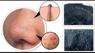 Очищаем нос от черных точек дома — быстро и эффективно Clear the nose of blackheads at home