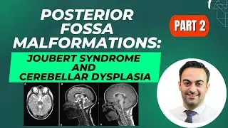 Posterior Fossa Malformations Part 2: Joubert Syndrome and Cerebellar Heterotopia and Dysplasia