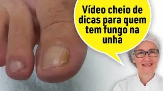 A UNHA DE UM SÓ DEDÃO TEM FUNGO