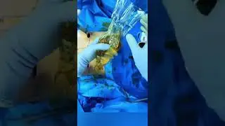 Breast implant insertion 