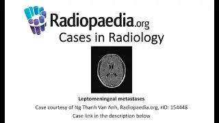 Leptomeningeal metastases (Radiopaedia.org) Cases in Radiology