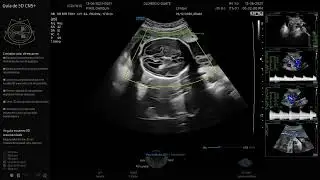OBSTET 2. Con el Hera w10 Elite.