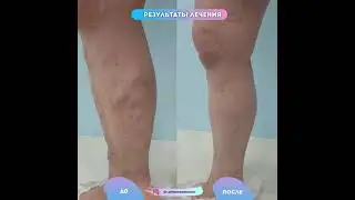 Результат после операции