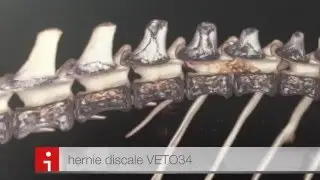 hernie discale